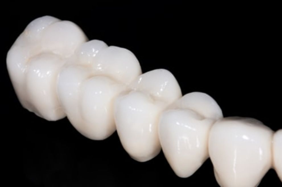 Имплантация зубов, лечение и протезирование в Екатеринбурге