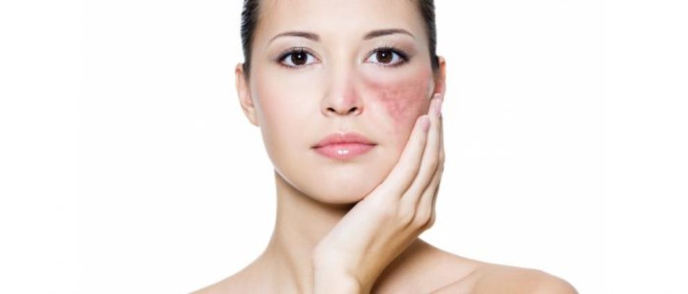 Эстетическая медицина: как удалить гемангиому лазером