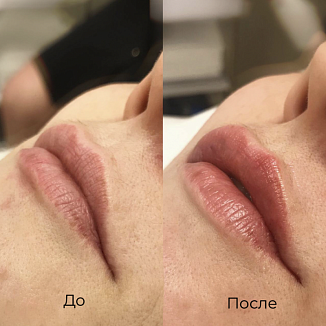 Увеличение губ в Москве в клинике Seline